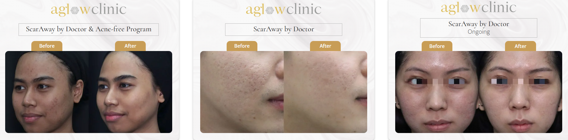 Acne scar before and after KL result 3
